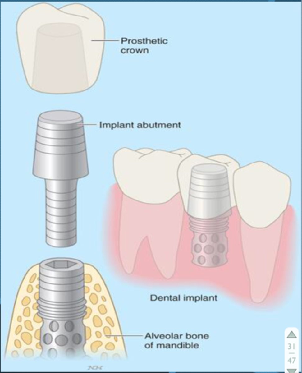 <p>Dental Implants</p>