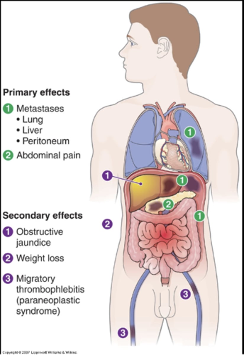 <p>Adenocarcinomas that arise in the ducts</p><p>Common</p><p>Usually older adults</p><p>Insidious</p><p>Know little about cause except that smokers 2X as likely to develop as nonsmokers</p><p>Most arise in the head & can obstruct the common bile duct</p><p>Those in the body & tail can be quite large by the time they are detected</p><p>½ die within 6 weeks of diagnosis</p><p>About 10% live a year</p><p>1% survive 5 years</p>