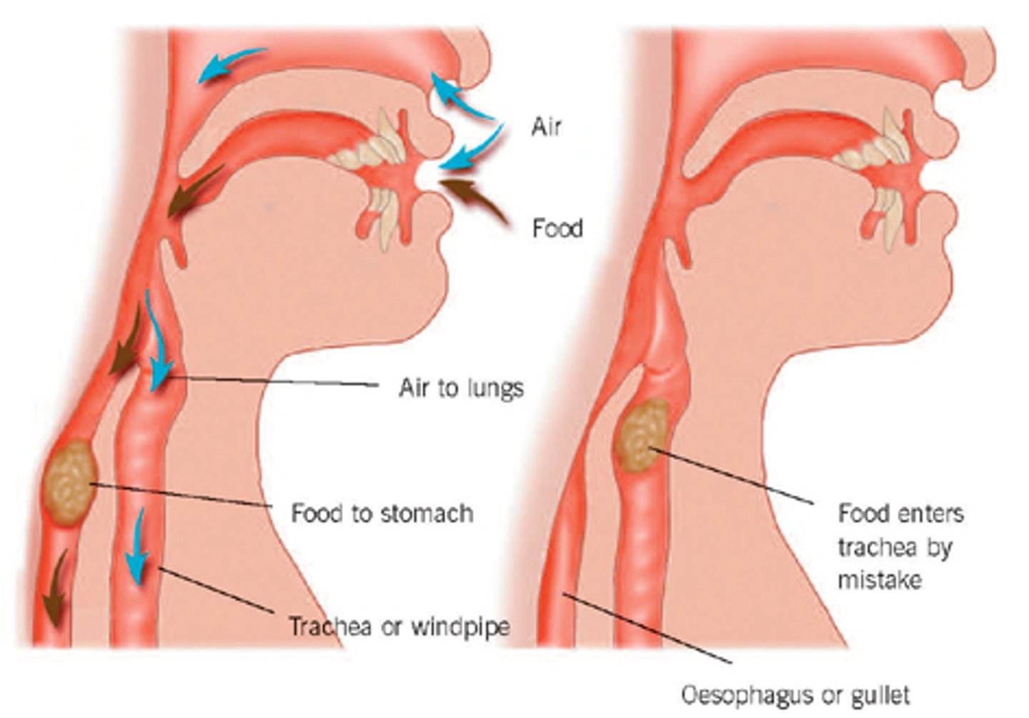 <p>Difficulty in swallowing</p><p>Can manifest in a variety of ways in the different phases of swallowing</p>