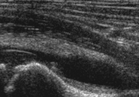 <ul><li><p>Small fluid effusions </p></li><li><p>Thickened synovial membrane + Doppler signal in acute phase </p></li><li><p>US guided joint punctures (Dg, therapeutic)</p></li></ul><p></p>