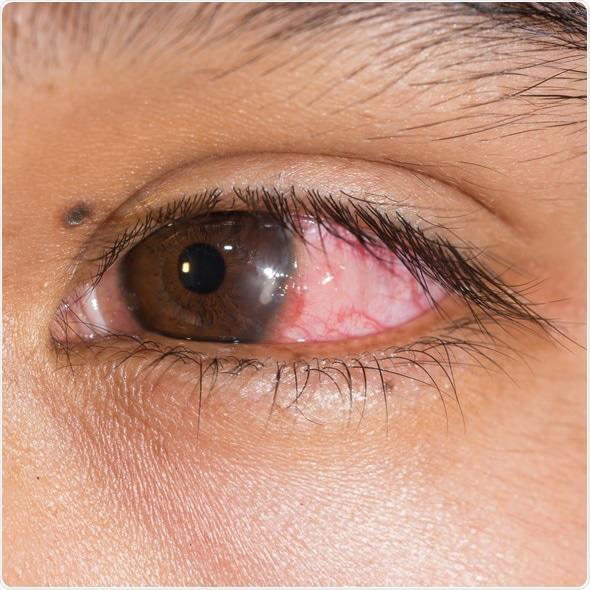 <p>Keratitis</p><p>•Eye redness</p><p>•Excess tears or other discharge</p><p>•Difficulty opening eyelid because of pain or irritation</p>