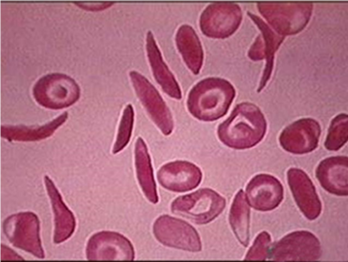 <p>What does this refer to</p><ul><li><p>Hemolytic anemia</p></li><li><p>Affects β–globin gene</p></li><li><p>Genetic defect in synthesis of Hgb S</p></li><li><p>“Sickled” shape —&gt; hemolysis and vascular occlusion</p></li><li><p>Includes</p><ul><li><p>Sickle cell disease</p></li><li><p>Sickle beta thalassemia</p></li><li><p>Hgb SC disease</p></li></ul></li><li><p>Sickle cell trait</p><ul><li><p>Usually asx</p></li><li><p>Doesn’t usually need tx</p></li></ul></li></ul><p></p>