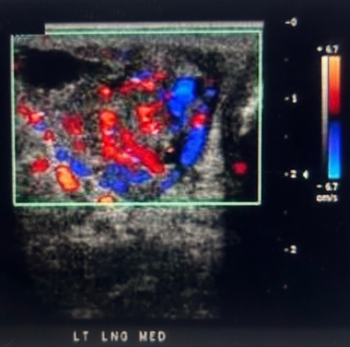 <p>The hypervascularity suggests orchitis</p>