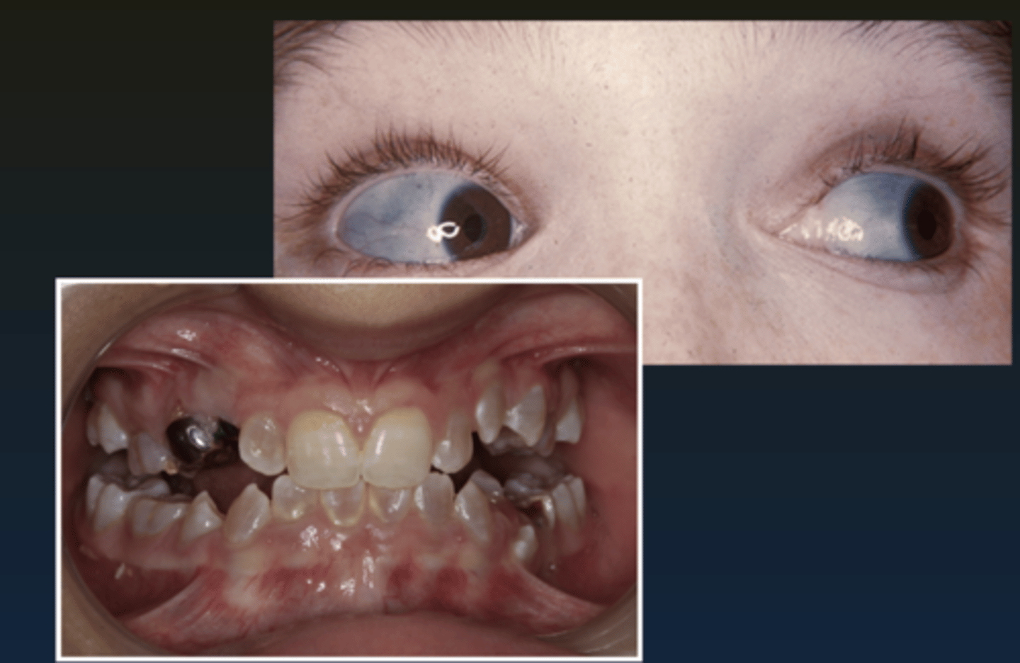 <p>genetic</p><p>• blue sclera of eyes + multiple bone fractures + joint hyperextension</p><p>• <strong>teeth = dentinogenesis imperfecta</strong></p><p>• population: children</p>