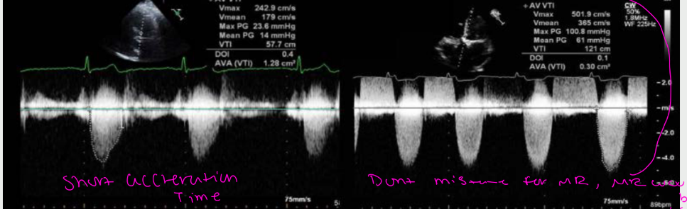 <p>normally the AV demonstrates a what waveform with a what acceleration time. Mild AS left demonstrates a ____ waveform with a what acceleration time. sever AS on the right demonstrates a what waveform with what acceleration time </p>