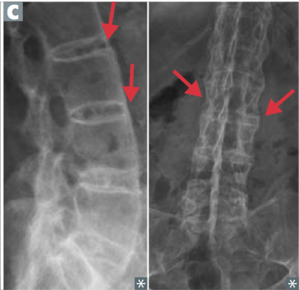 <p>What is it?</p><p>- one of the seronegative spondyloarthropathies (PAIN)</p><p>- associated with HLA B27</p><p>- more common in males (young, 20s)</p><p>Findings?</p><p>- symmetric involvement of spine and sacroiliac joints --> ankylosis (joint fusion), uveitis, aortic regurgitation</p><p>- bamboo spine (vertebral fusion)</p>