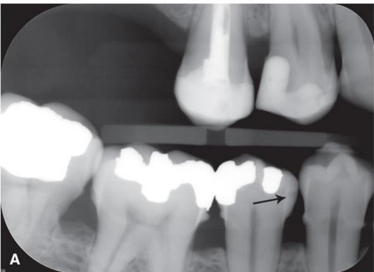 <p>classify this lesion according to the ADA and ICDAS/ICCMS systems </p>