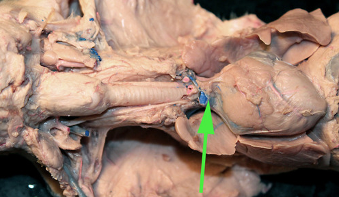 <p><span>The cut off segment of vessel marked by the green arrow is the </span><strong>superior vena cava</strong></p>