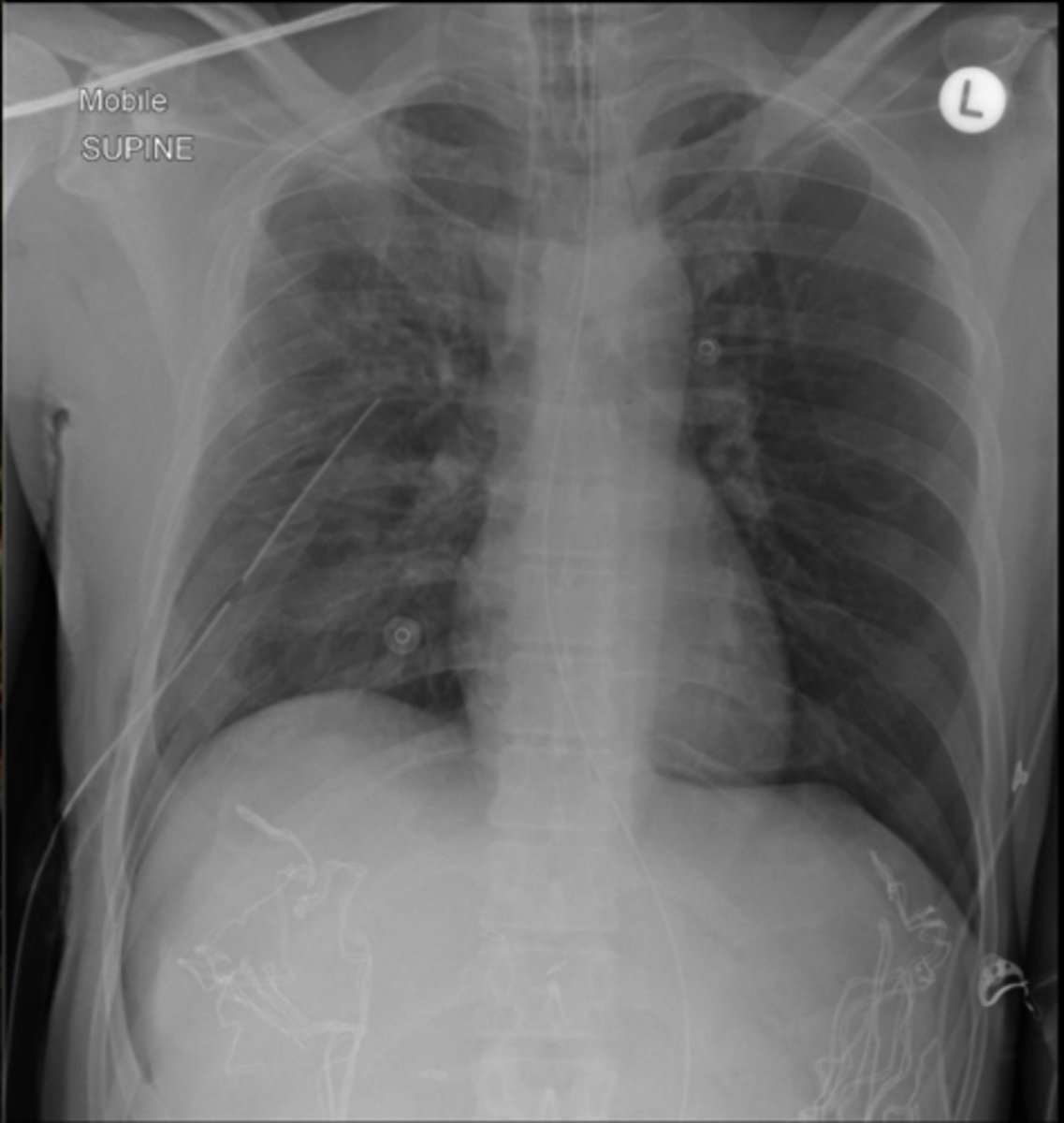 <p>What sign do you see in this CXR?</p>