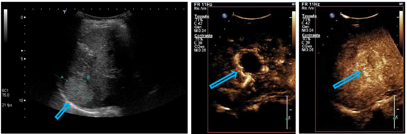 <p>Patient history: </p><p>Modality: asymptomatic young patient, routine abdominal ultrasonography followed by CEUS work-up left – convex probe, B mode US; middle – contrast-enhanced ultrasonography (CEUS) after iv. microbubble administration, arterial phase; right – CEUS, late phase </p><p>Region: liver, right subcostal view </p><p>Radiologic sign: Hyperechoic, well-circumscribed hepatic mass showing peripheral nodular enhancement in the arterial phase and complete filling in the late phase. </p><p>Diagnosis: hepatic hemangioma</p>