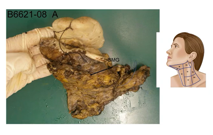 <p>anterior tongue, floor of mouth and gingival mucoperiosteum </p><p>fibrofatty tissue of the upper central and left lateral neck 1,2,3,4 contain the tymph nodes - yellow-bown </p>