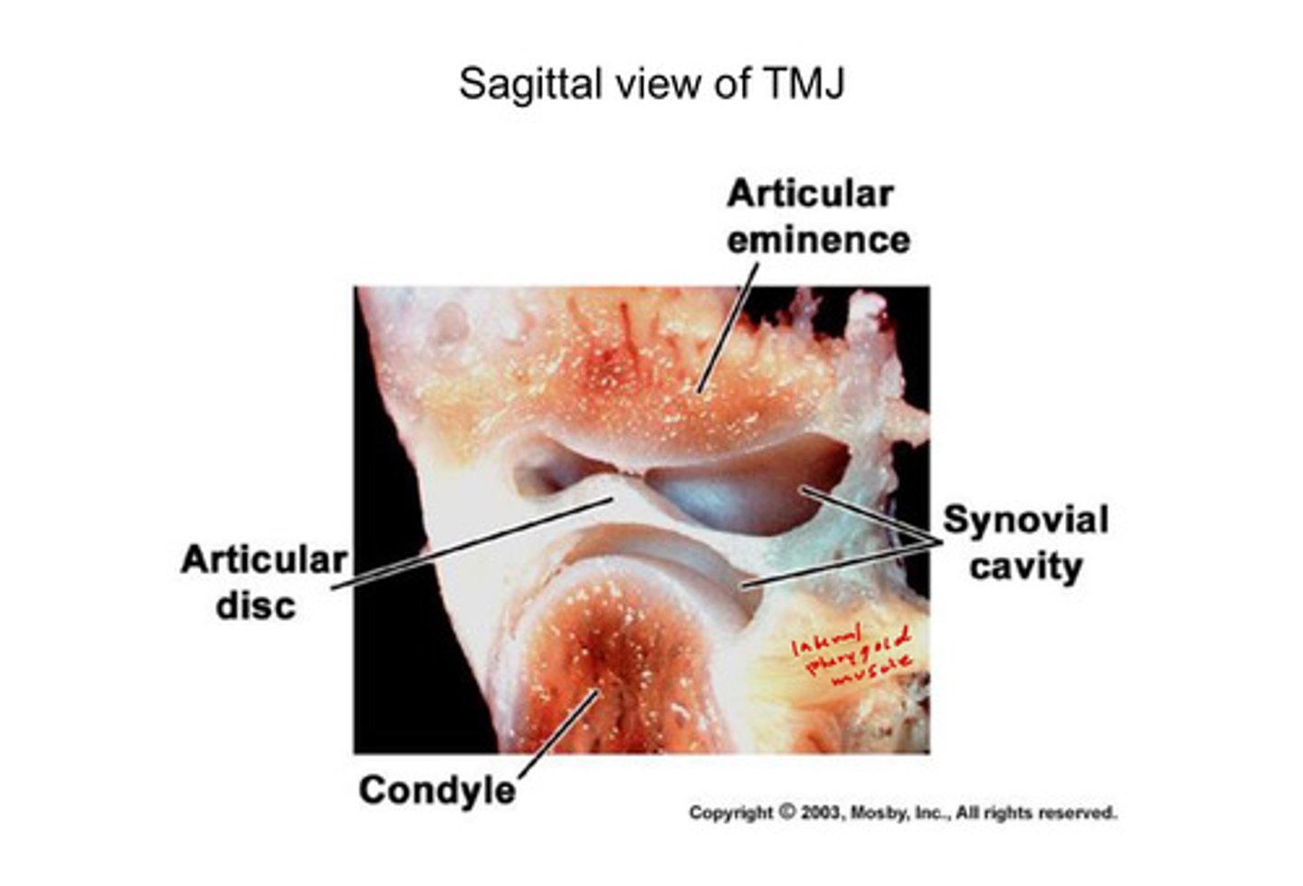 <p>note that you can see the superior and inferior synovial cavities; the lateral pterygoid muscle is also visible</p>