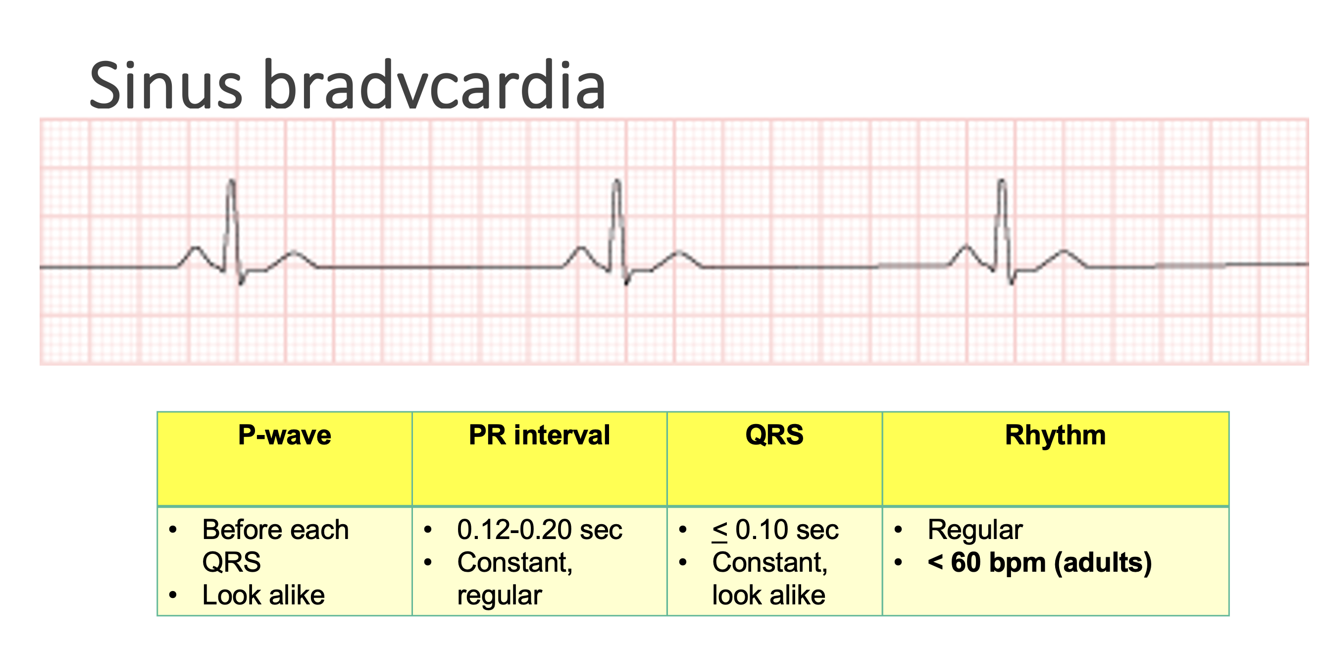 <p>Sinus bradycardia</p>