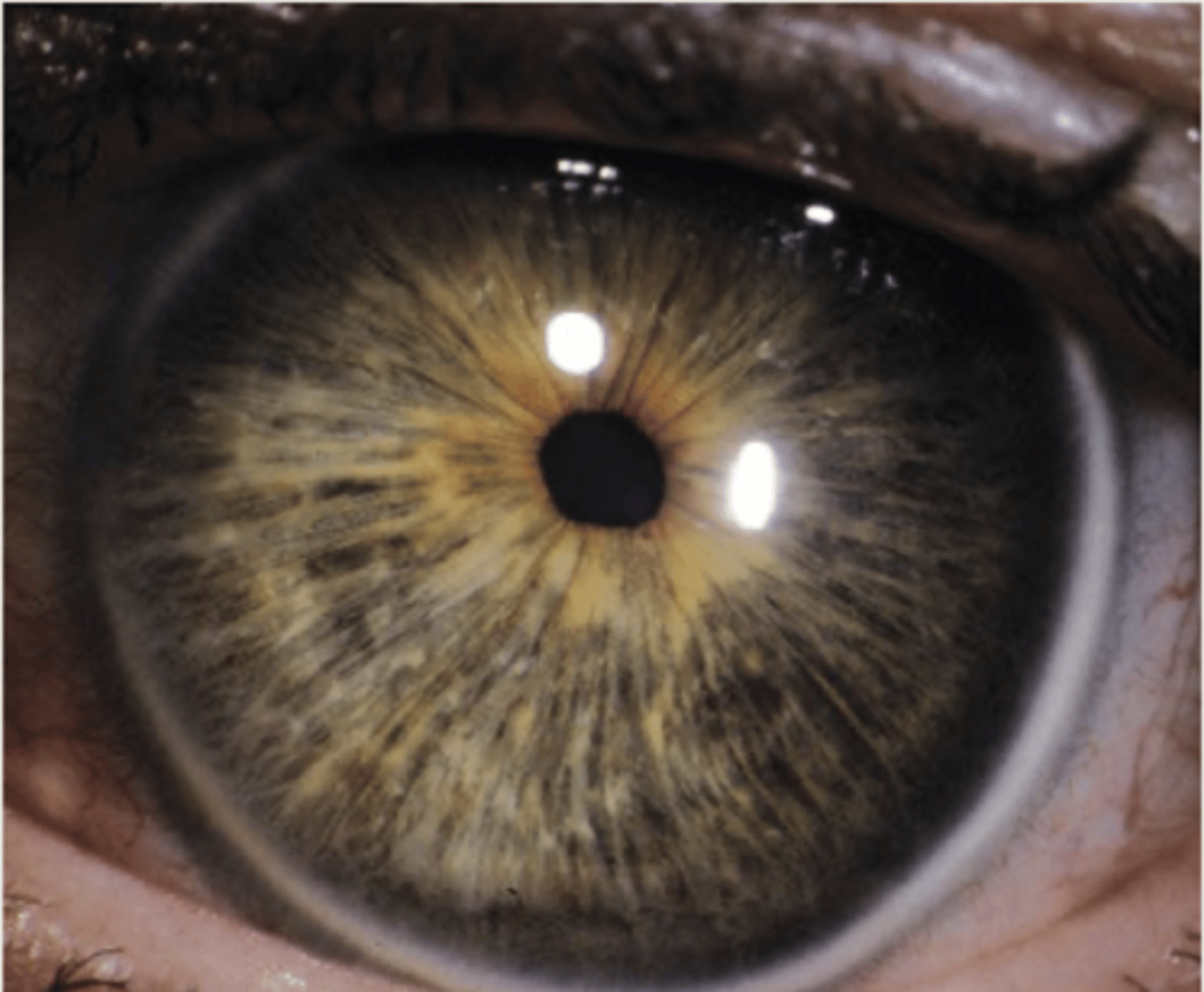 <p>1. large cornea</p><p>2. deep anterior chamber</p><p>3. high myopia and astigmatism</p><p>4. lens subluxation</p><p>5. pigment dispersion syndrome</p>