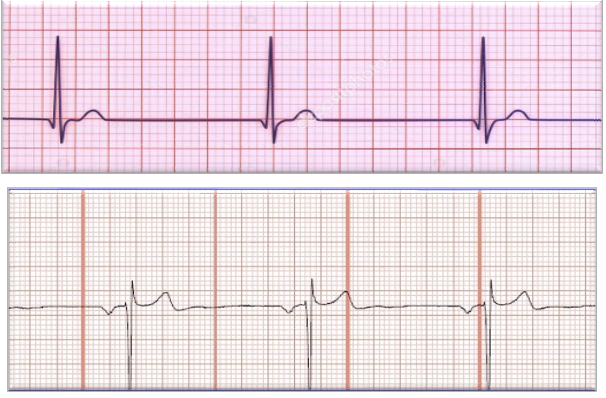 <ul><li><p class=""><strong>Rate</strong>: Atrial — 40 to 60 bpm (if there is retrograde conduction); Ventricular — 40 to 60 bpm</p></li><li><p class=""><strong>Rhythm</strong>: Regular</p></li><li><p class=""><strong>P Waves</strong>: May be absent, may be inverted</p></li><li><p class=""><strong>P to QRS Ratio</strong>: 1:1 or 0:1</p></li><li><p class=""><strong>PR Interval</strong>: If the P wave is in front of the QRS, the PR interval is less than 0.12 seconds</p></li><li><p class=""><strong>QRS Complex</strong>: Usually normal</p></li></ul><p></p>