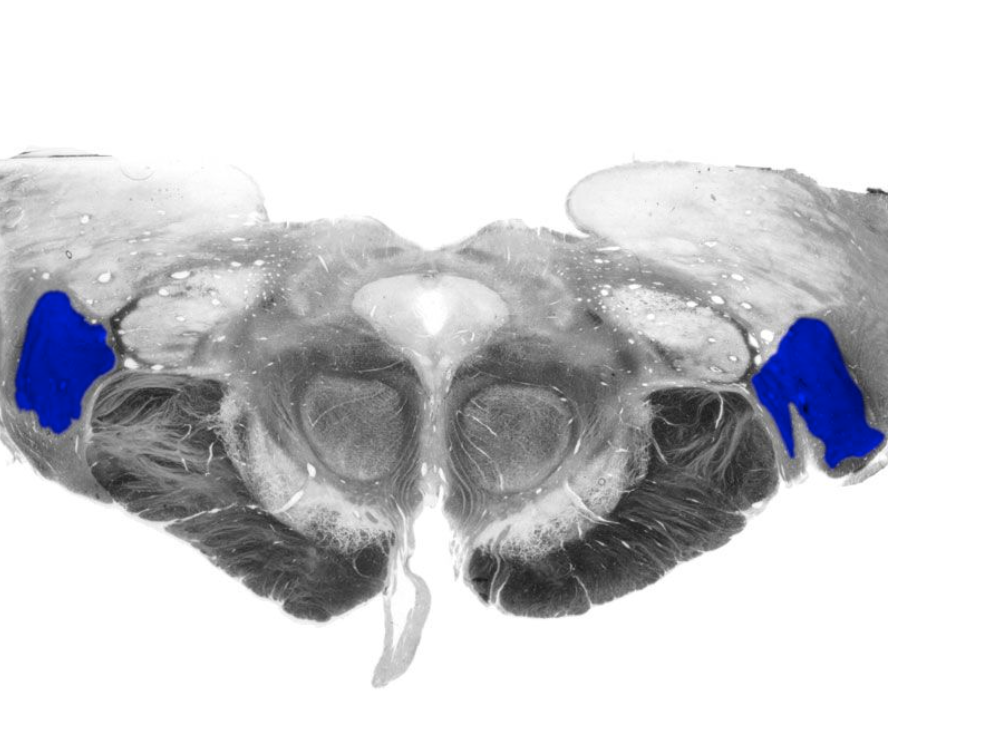 <p>Nucleus of the posterior, dorsal thalamus that receives the axonal projections of retinal ganglion cells via the optic tract, projects to the primary visual cortex (Brodmann's area 17) in the calcarine sulcus of the occipital lobe.</p>