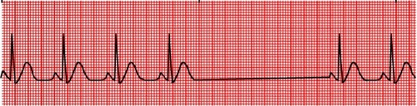 <p>Normal sinus rhythm with "dropped beats"</p><p>An entire PQRST is missing (period of asystole)</p><p>Scariest of all sinus arrhythmias</p>