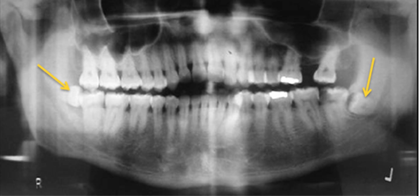 <p>Gardner's Syndrome, Cleidocranial Dysplasia</p>