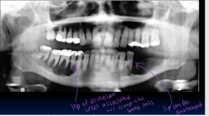 <p>-Langerhans Cell Histiocytosis 1</p><p>-neoplasm</p><p>-”ice cream scoop”-like bone destruction</p>