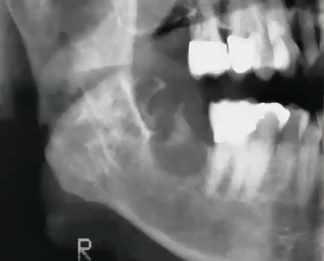 <p>This is only salivary gland tumor that can occur in the bone</p>