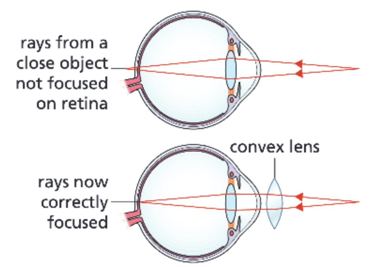 <p>Hyperopia is when distant objects can be seen but not close ones. This happens because the light focuses behind the retina, meaning the image is blurry. This may happen because the lens is too flat or thin, or the person has a particularly short eyeball; this means that the lens can’t refract the rays of light strongly enough. This can be treated using glasses with a convex lens, which bring the rays closer together, so they can be focussed on the retina</p>