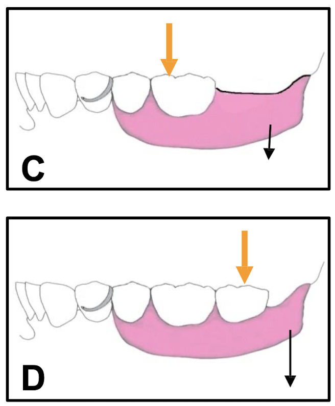 <p>occlusal load applied</p>