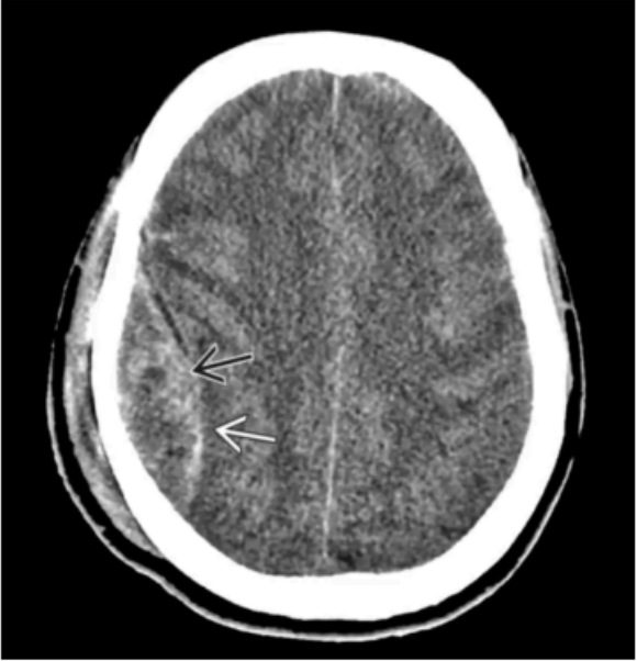 <p>Epidural Hemorrhage </p>
