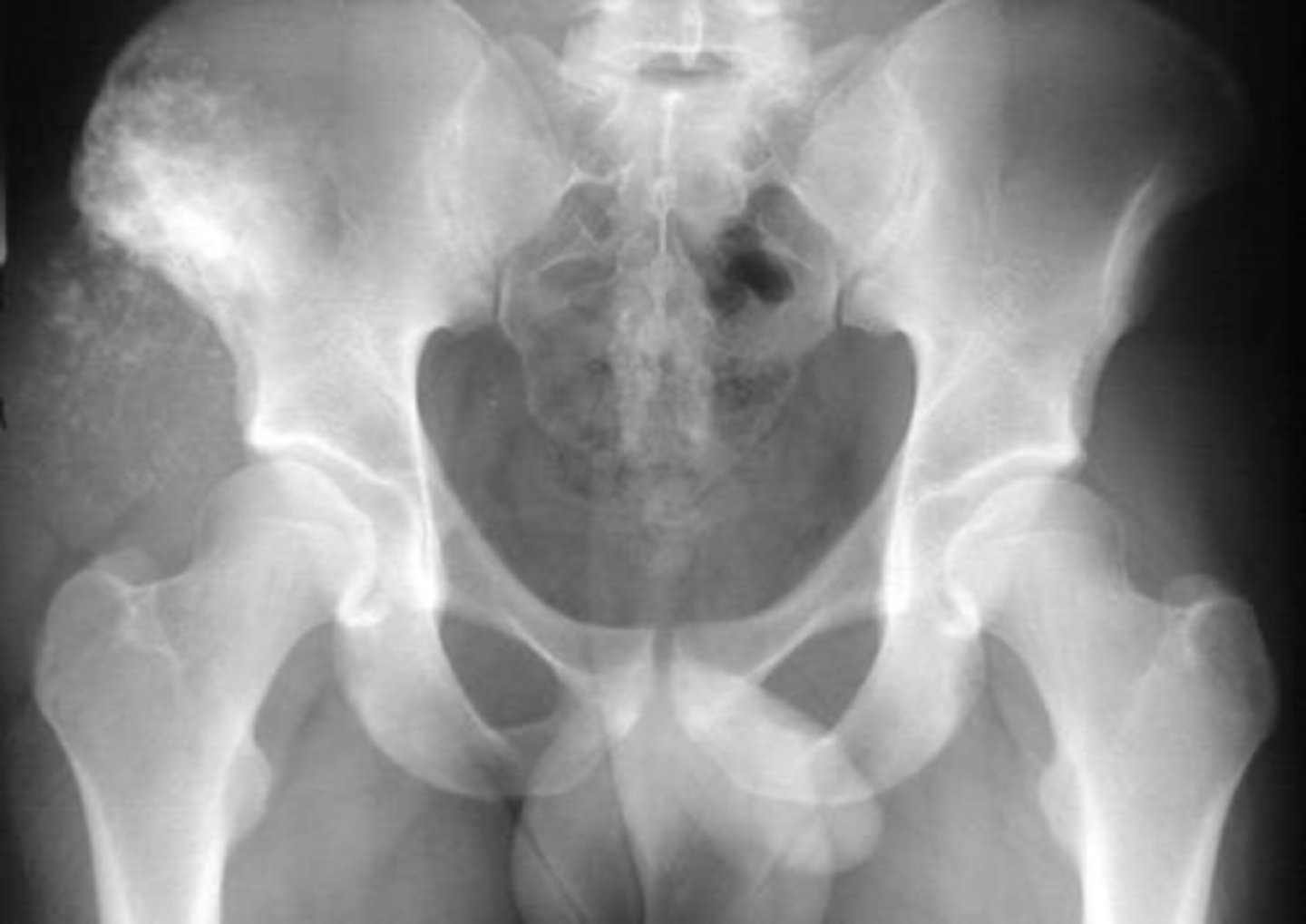 <p>Chondrosarcoma has a _____ 5-year survival after surgery</p>