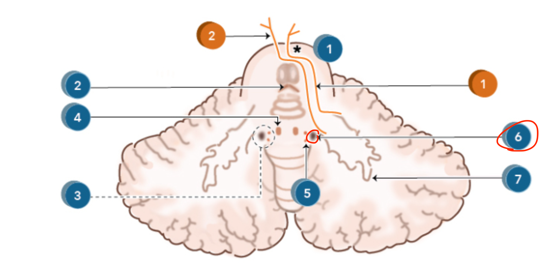 <p>Emboliform nucleus</p>