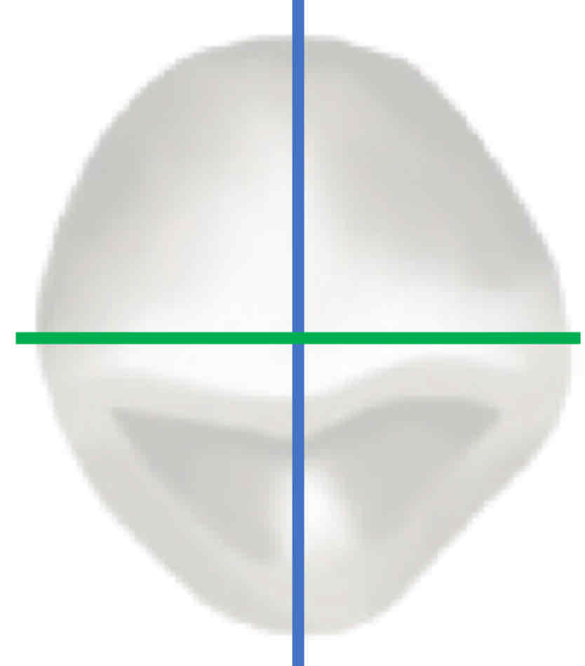 <p>fill in the blank: labial/lingual dimension is ____ than the mesiodistal</p>