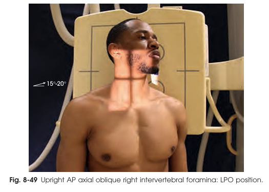 <ul><li><p>Patient sits/stands straight, adjacent shoulder firmly against grid for support.</p></li><li><p>Ensure true 45° body rotation.</p></li><li><p>Chin elevated/protruded to avoid mandible overlap of spine. Do not turn chin to the side; this could rotate upper vertebrae.</p></li></ul><p></p><p>AP axial oblique projection of the cervical intervertebral foramina</p>