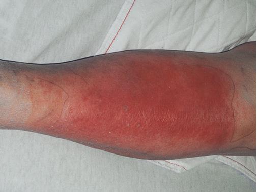 <p>1day hx fever &amp; erythema of extremity. overnight it worsens, increasingly severe pain hx of partial masectomy &amp; radiation therapy. had edema that side since. bright red, well-demarcated area extremely sensitive to the touch</p>