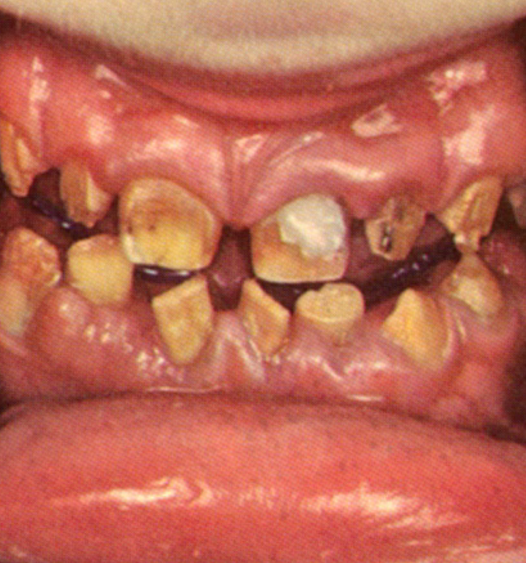<p>Amelogenesis </p>