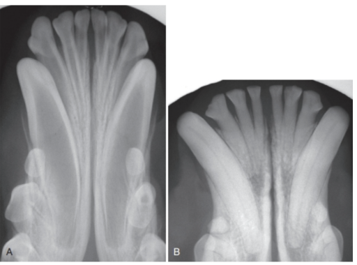 <p>Which patient is older: A or B? How do you know this from looking at the radiographs?</p>