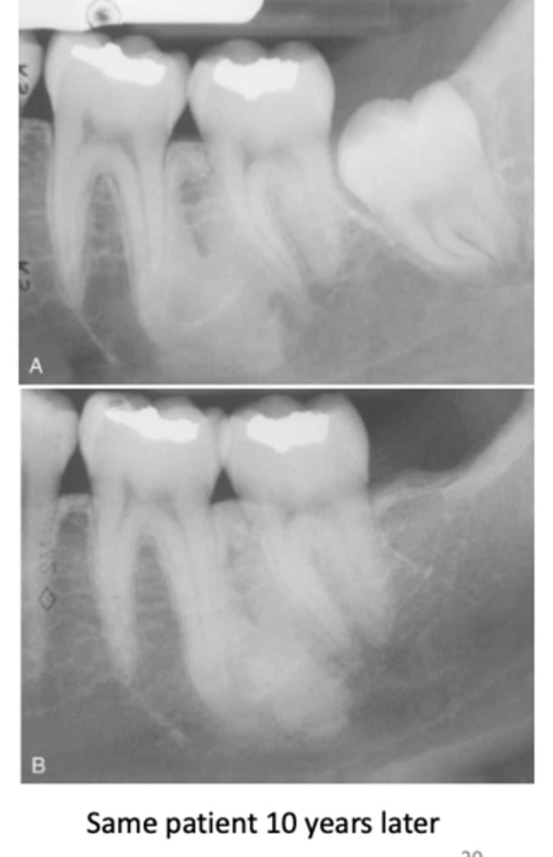 <p>What do radiographic signs show in Idiopathic Osteosclerosis </p>
