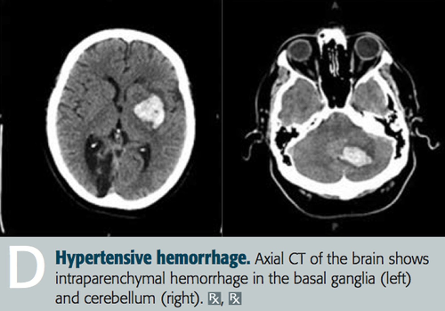 <p>Hemorrhages = Hyperdense</p><p>Infarctions = Hypodense</p>
