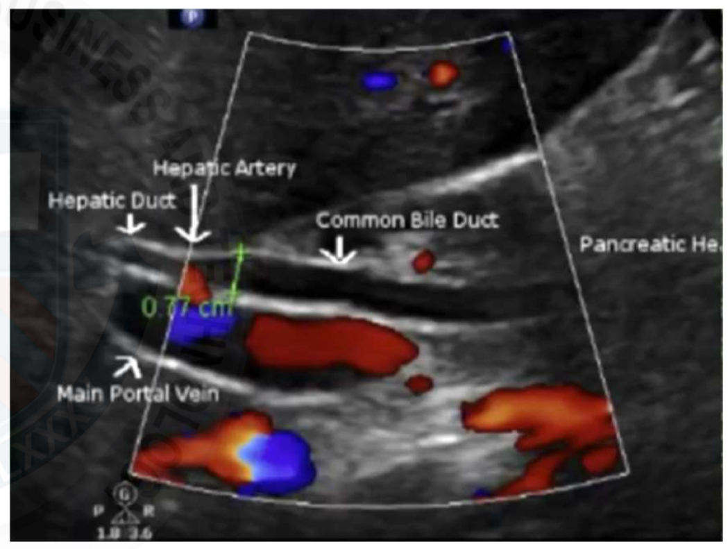 <p><span style="color: rgb(203, 213, 225)">Dilation of CBD&nbsp;</span></p><p>Increase of CBD size by 1mm per decade over 50 years old considered normal&nbsp;</p><p>Also after a cholecystectomy&nbsp;</p><p>Not considered dilated until greater 10 mm&nbsp;</p><p><br></p>