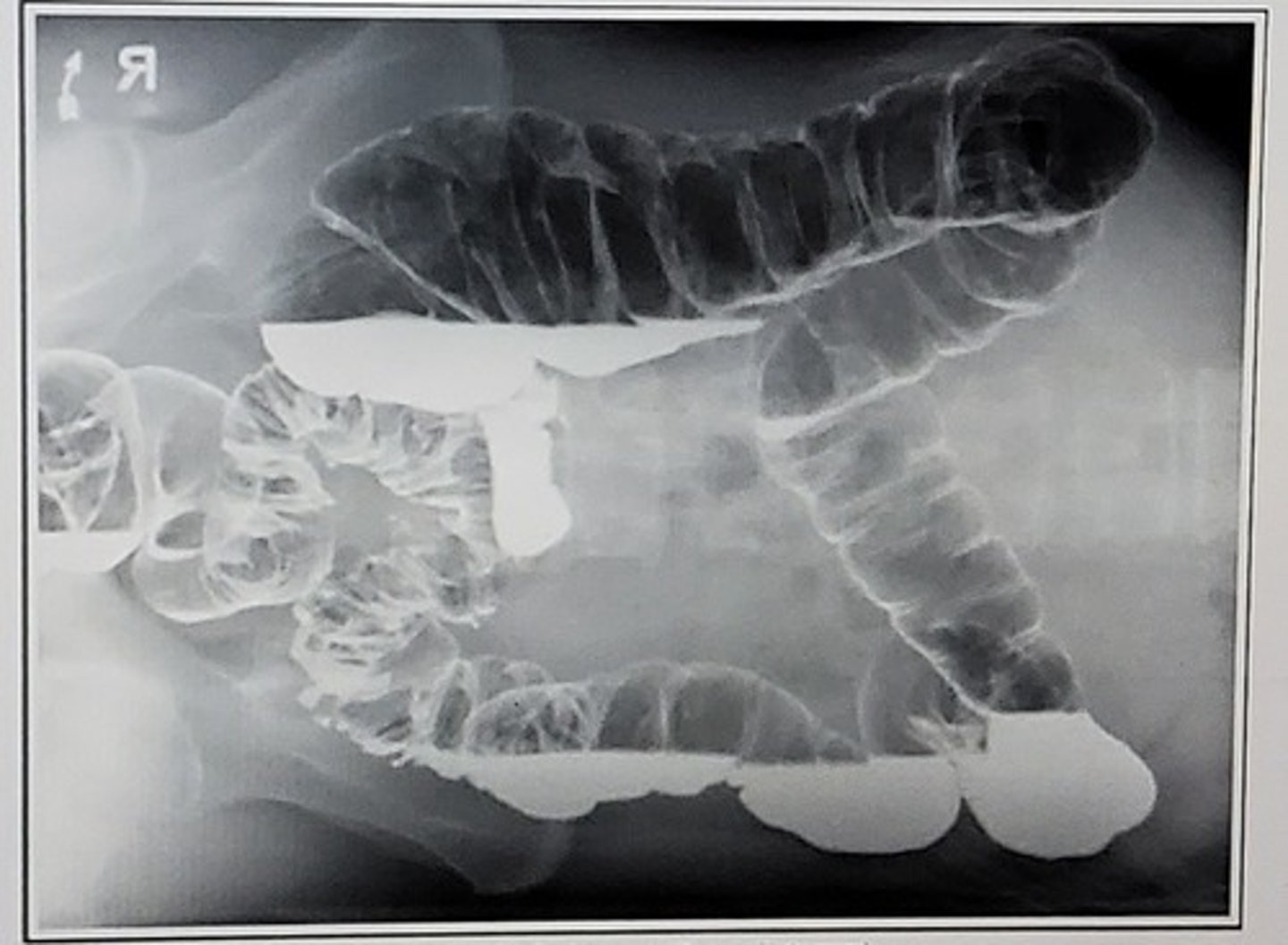 <p>What position is this?</p><p>A. Right lateral decubitus</p><p>B. AP</p><p>C. Left lateral decubitus</p><p>D. AP axial</p>