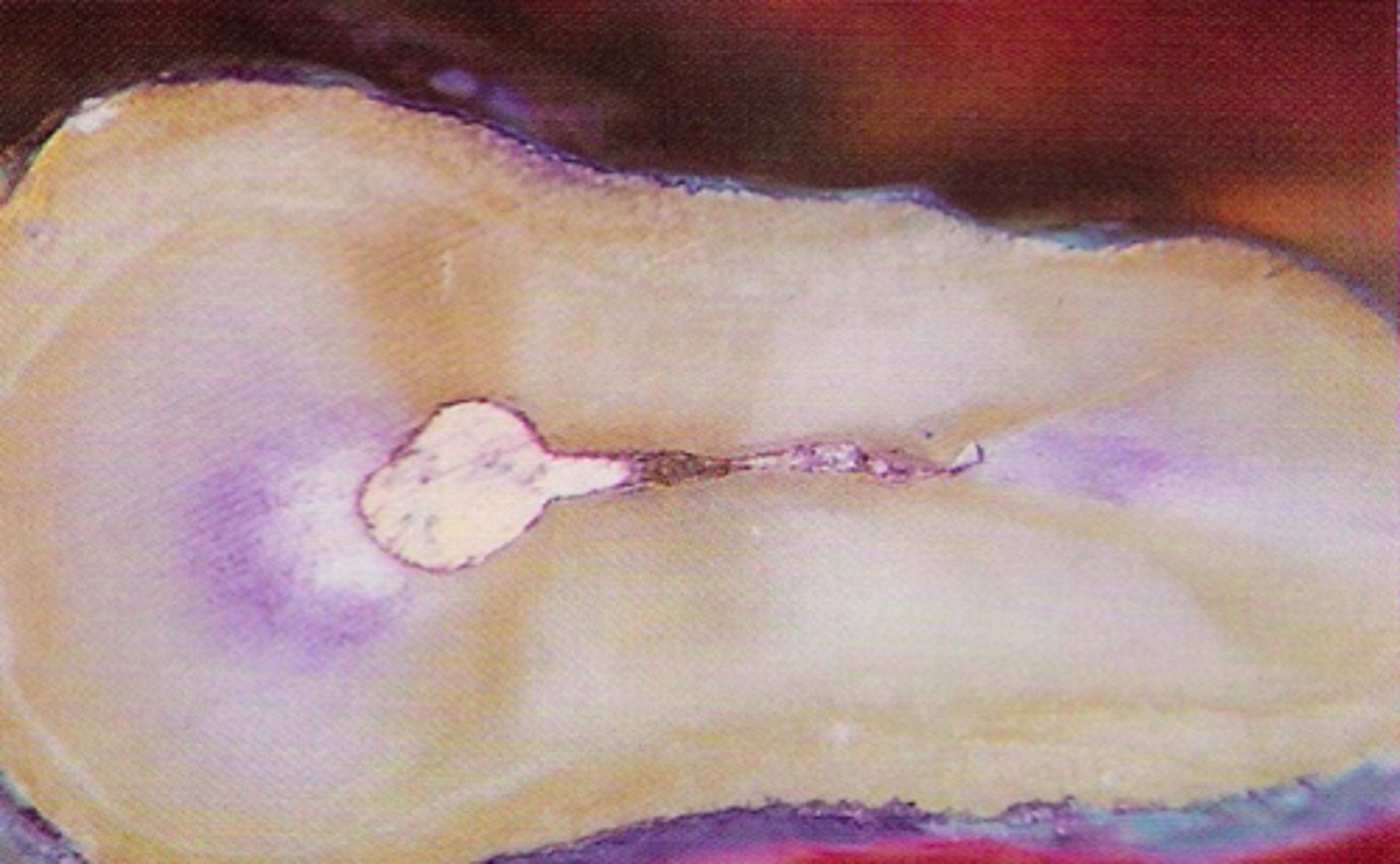 <p>ID the surgical procedure:</p><p>- Root end resection</p><p>- Root end preparation</p><p>- Root end filling</p>