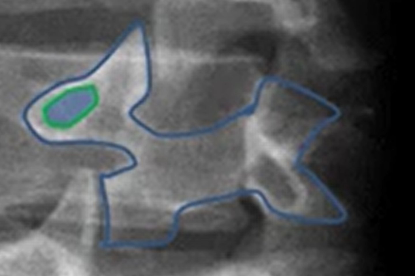 <p>pars interarticularis</p>