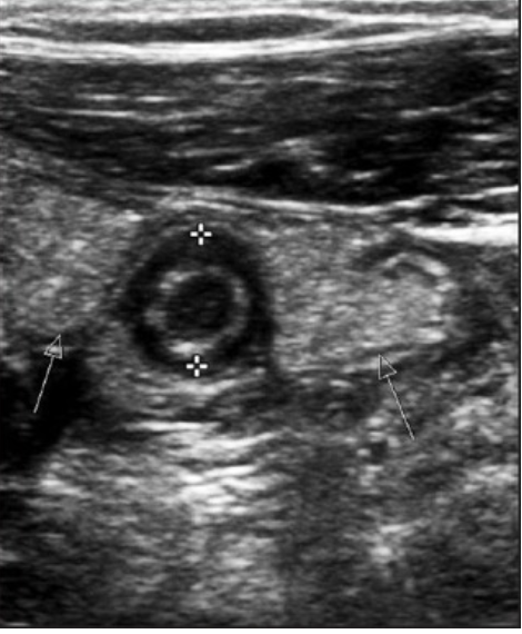 <p>“doughnut sign” or “bullseye sign” of <strong>______ </strong>on ultrasound due to <span>concentric alternating echogenic and hypoechoic bands</span></p>