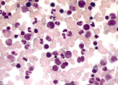 <p>What disease is shown</p>