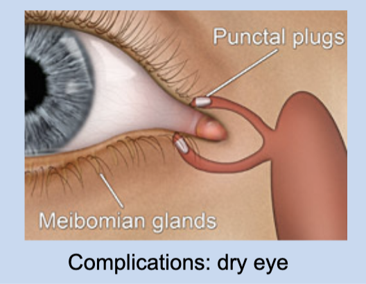 <p>dry eyes from defective film layer (Tx: using punctal silicon plugs to lessen drainage of tears)</p>