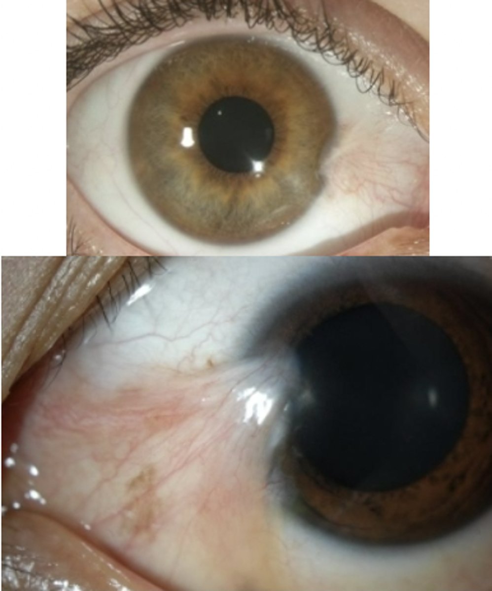 <p><u>Risk factors</u>: associated w/ UV exposure; surfers, farmers, lawn care workers, construction workers; sand or dust exposure</p><p><u>S&amp;S</u>: <strong>triangular wedge</strong> on conjunctiva that <strong>crosses to cornea</strong></p><p><u>Tx</u>: no tx until it crosses the VA, referral to optho for routine following, prevention: wear eye protection</p>