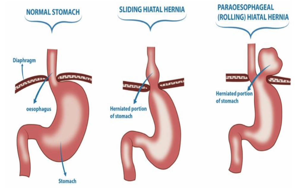 <ol><li><p><strong>sliding:</strong> stomach herniates through diaphragmatic hiatus</p></li><li><p><strong>paraesophageal (rolling)</strong>: stomach protrudes through separate defect alongside esophagus </p></li></ol><p></p>