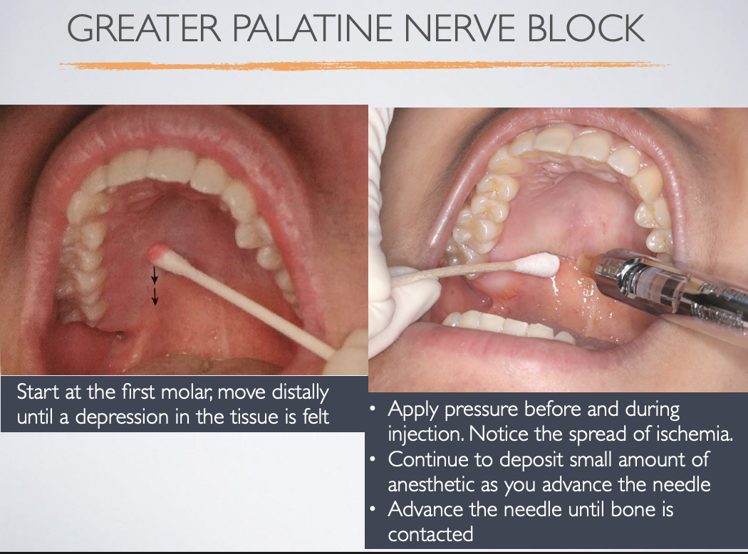 <p>first molar (move distally until depression is felt)</p>
