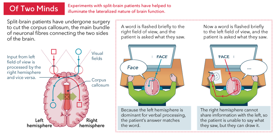 <p>corpus callosum cut in epileptics, and sides cannot communicate</p>