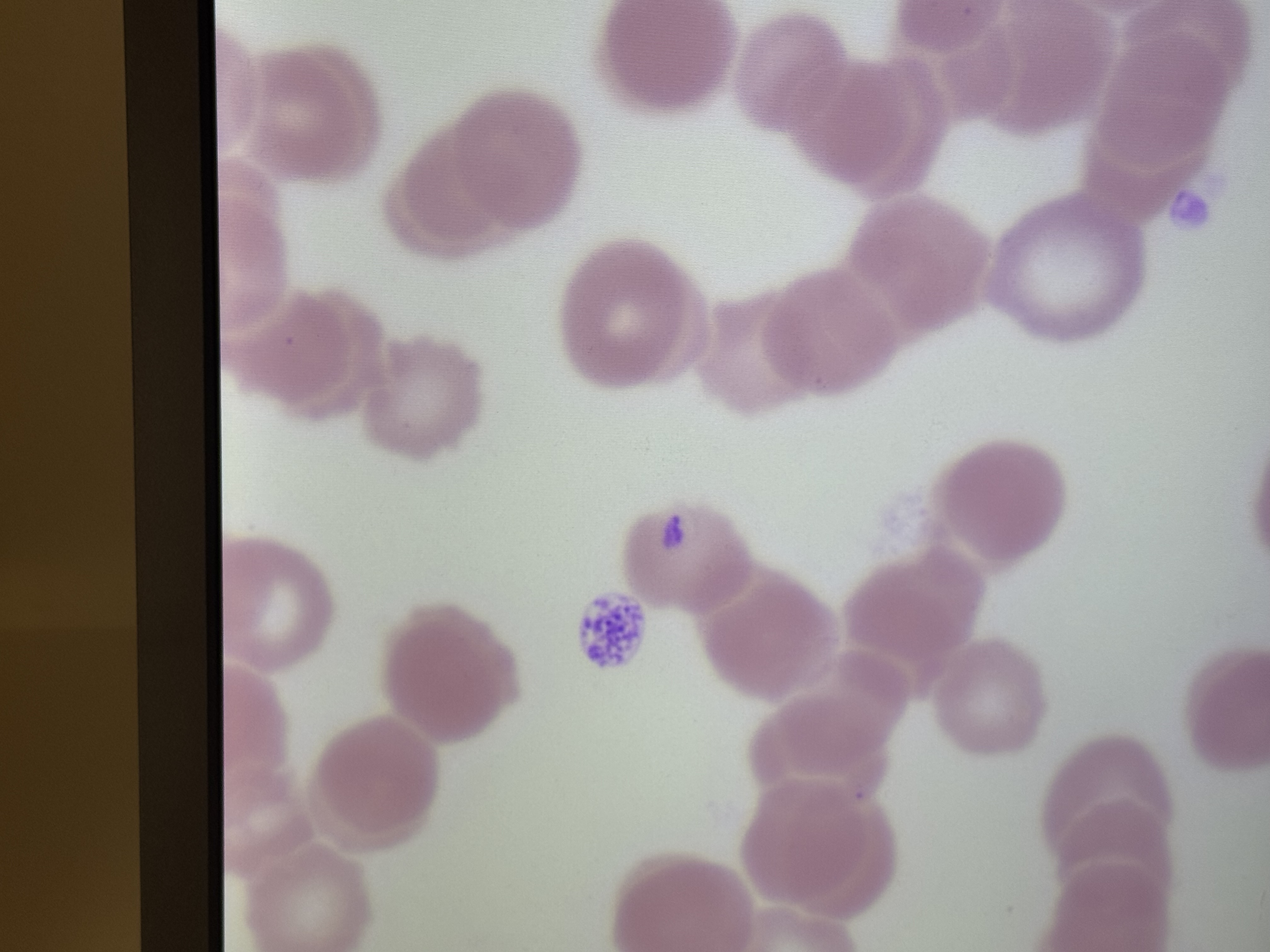 <p>Plasmodium Vivax</p>