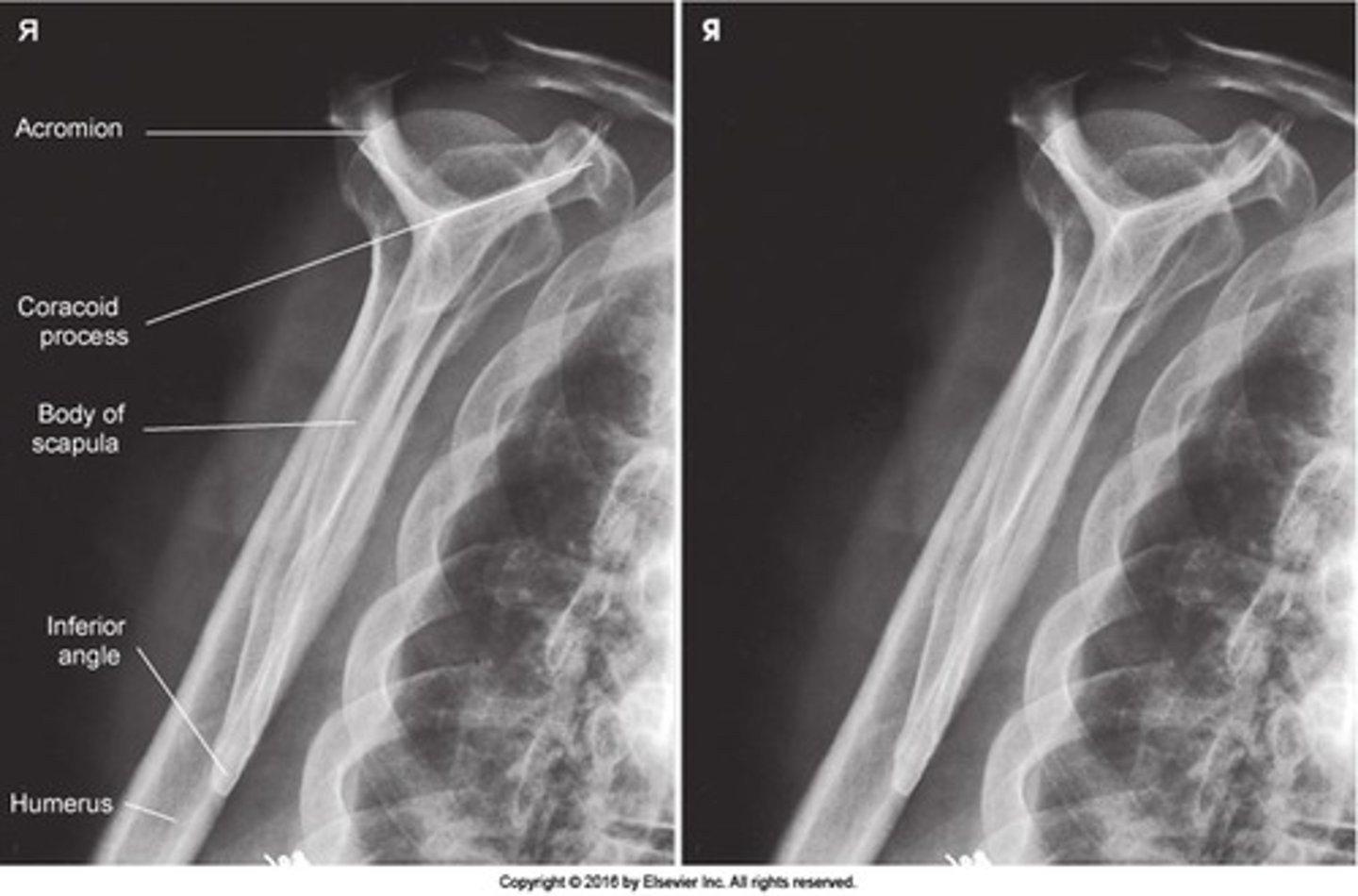 <p>- acromion</p><p>- coracoid</p><p>- lateral and verterbral borders</p>