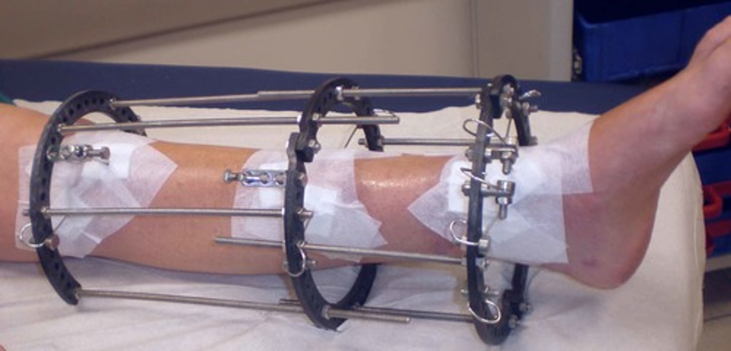 <p>- reduces fracture into place. can be through:</p><p>- manual pulling</p><p>- skeletal traction (via pins/wires/pulleys to pull the bone &amp; straighten it)</p>